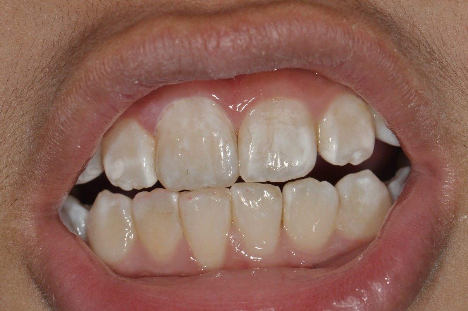 What To Do About White Spots On Your Teeth In Solihull And Coventry