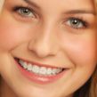 Traditional braces