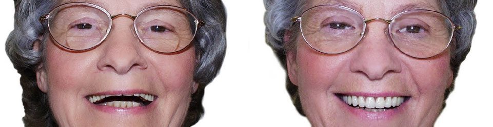 Dentures