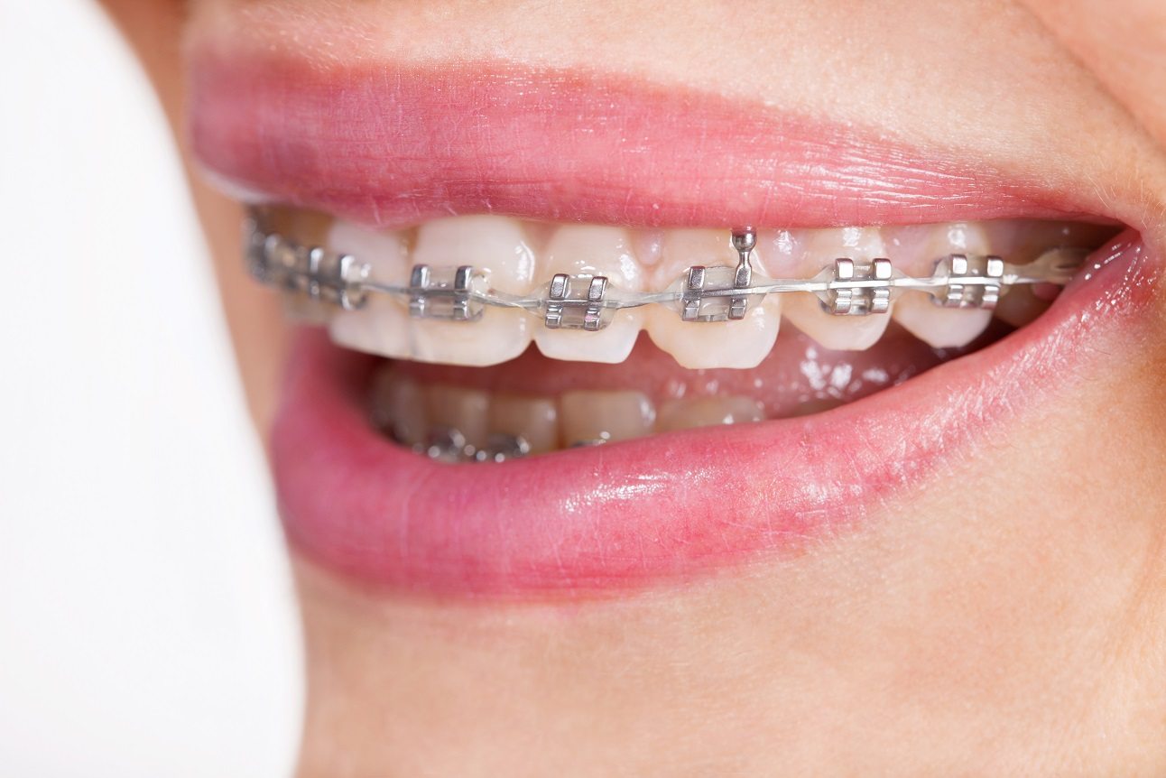Optagelsesgebyr Uganda Bidrag How to Correct Protruding Front Teeth in Adults - Balsall Common Dental