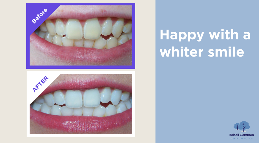 Teeth Whitening before and after