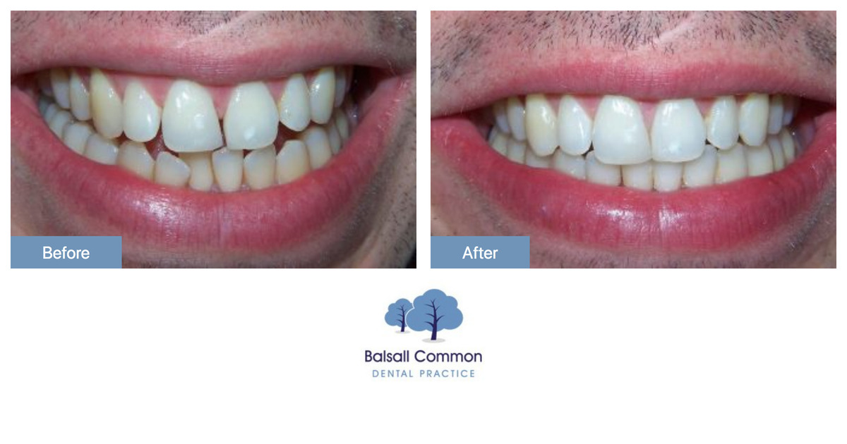 Clear Aligners And Whitening Balsall Common Dental Practice