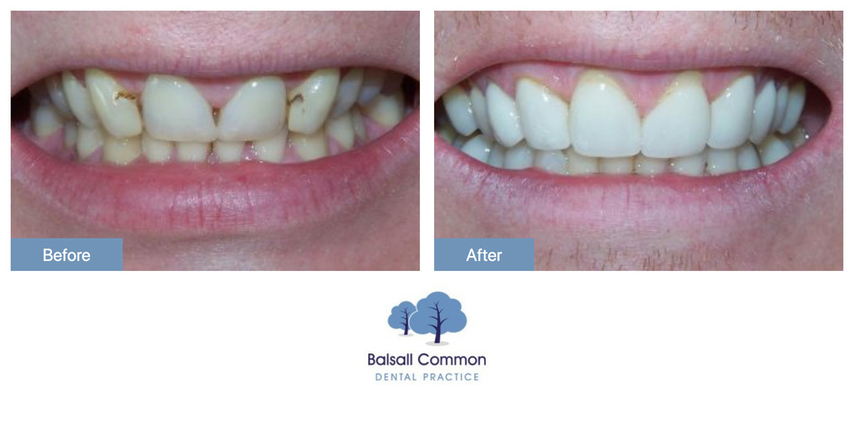 Veneers and Whitening Balsall Common Dental Practice