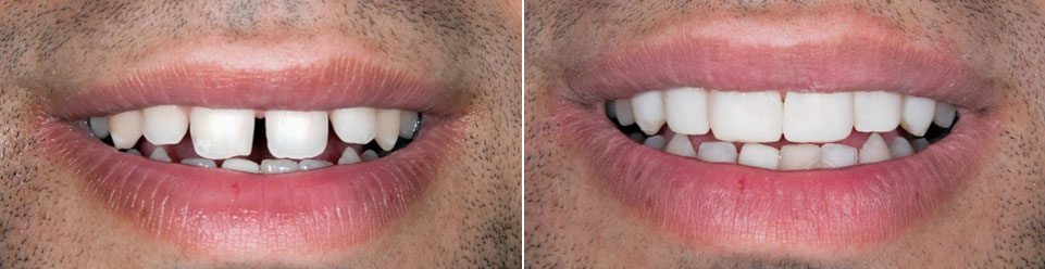 Veneers