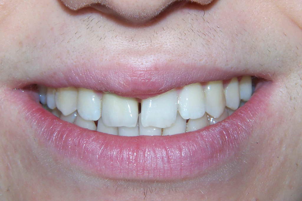 The Reason Why Gums May Look White Balsall Common Dental