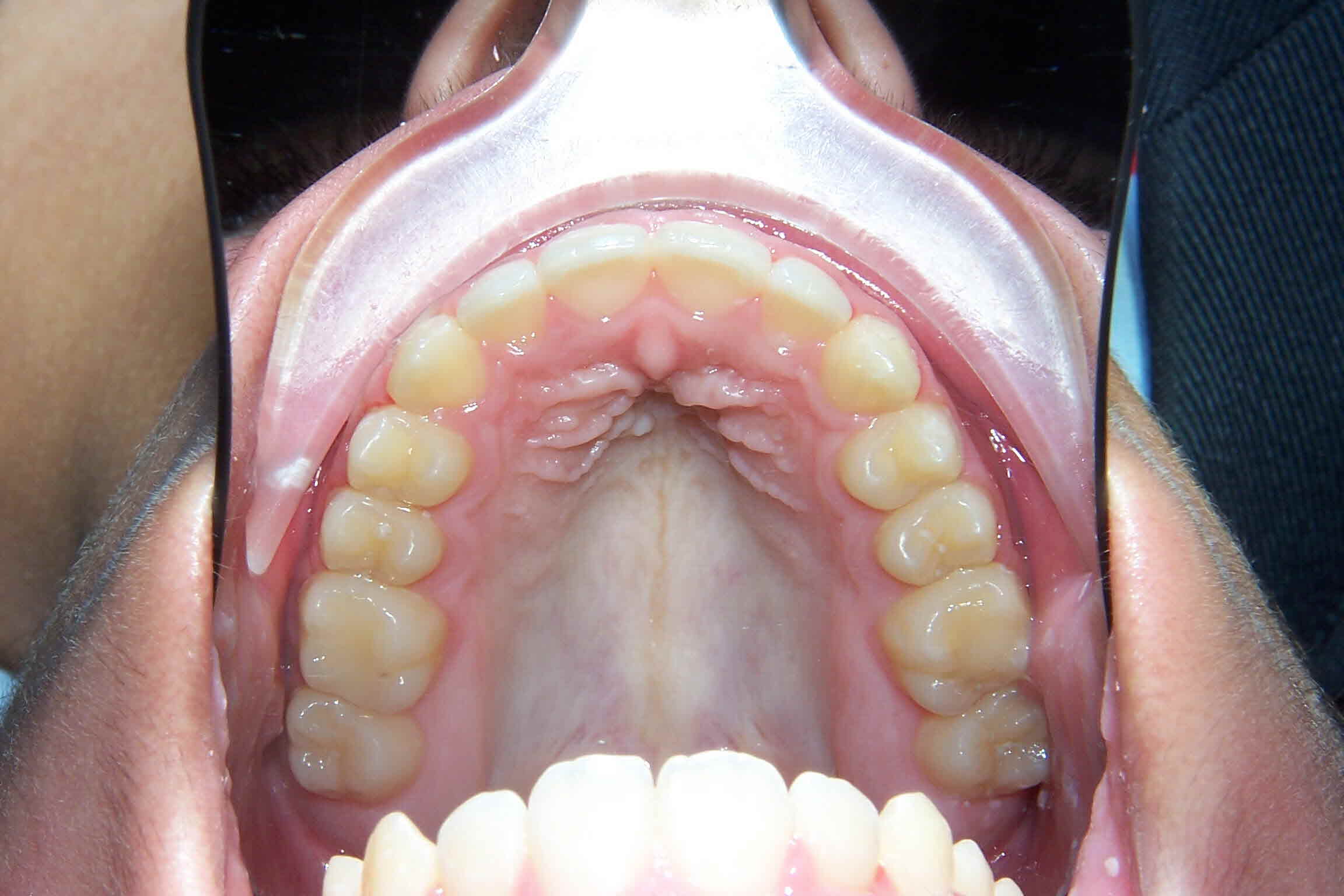 Lingual Braces Balsall Common Dental