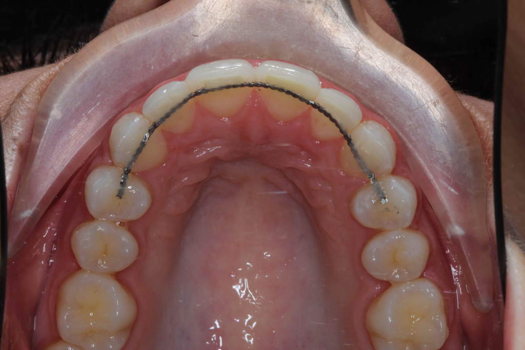 Lingual Braces Balsall Common Dental