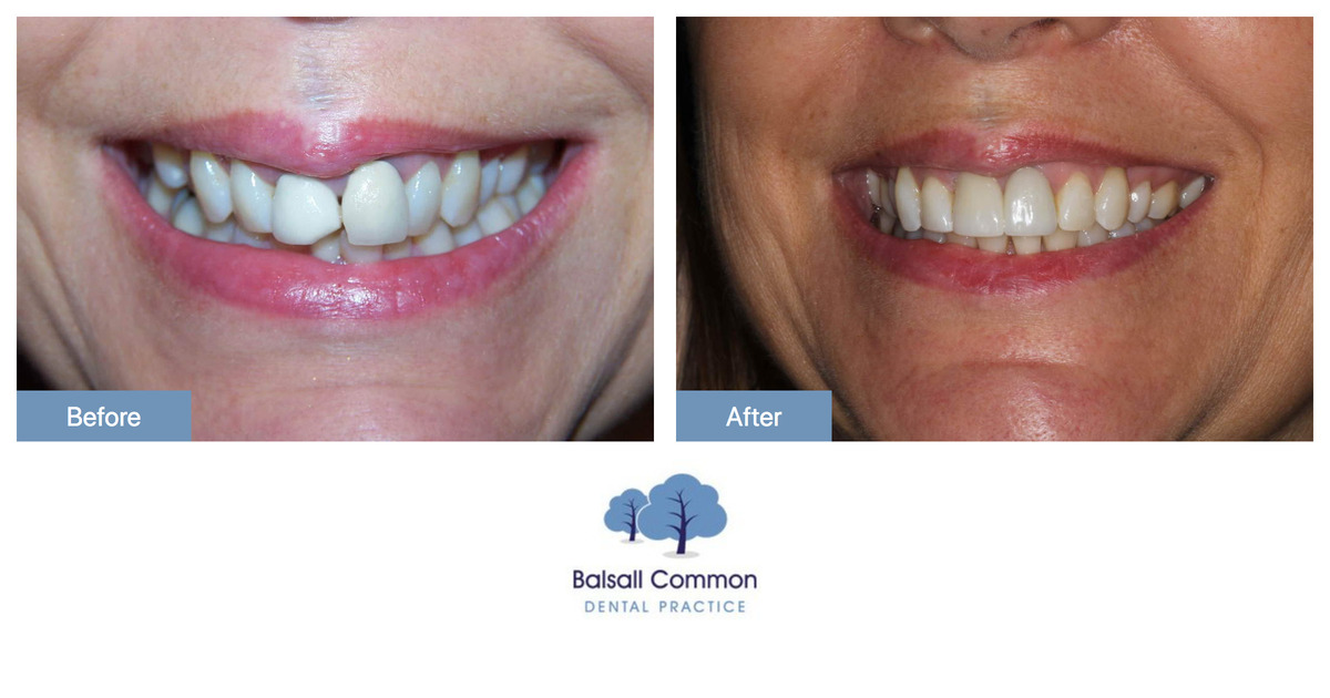 Fixed braces and crowns Balsall Common Dental