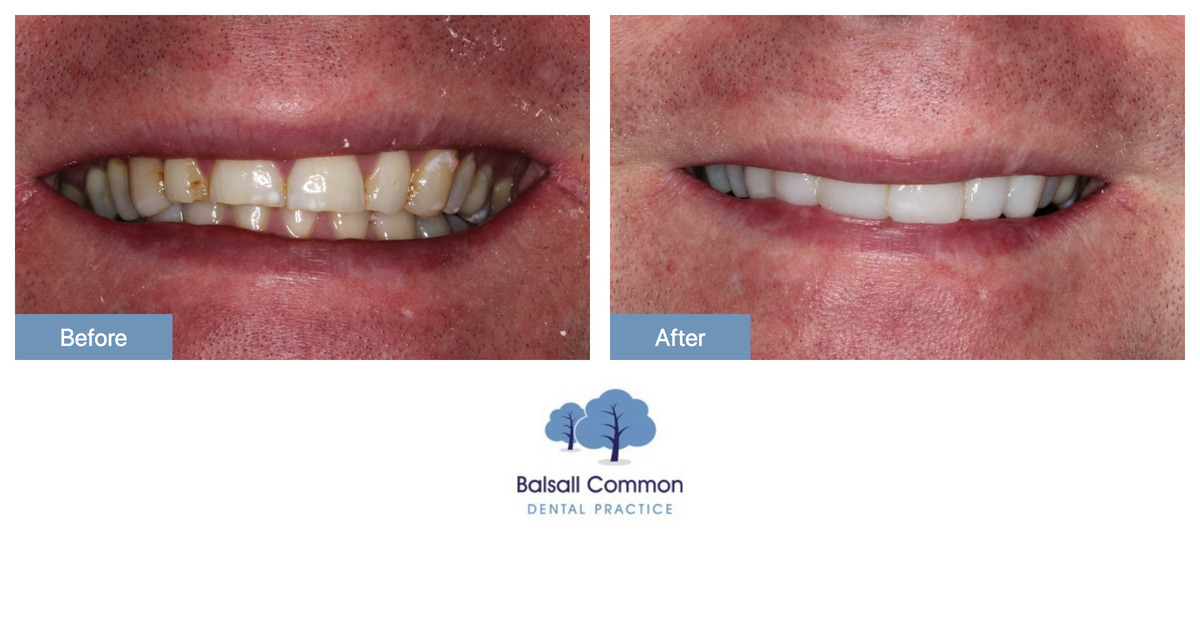 Tooth whitening and composite bonding Balsall Common Dental