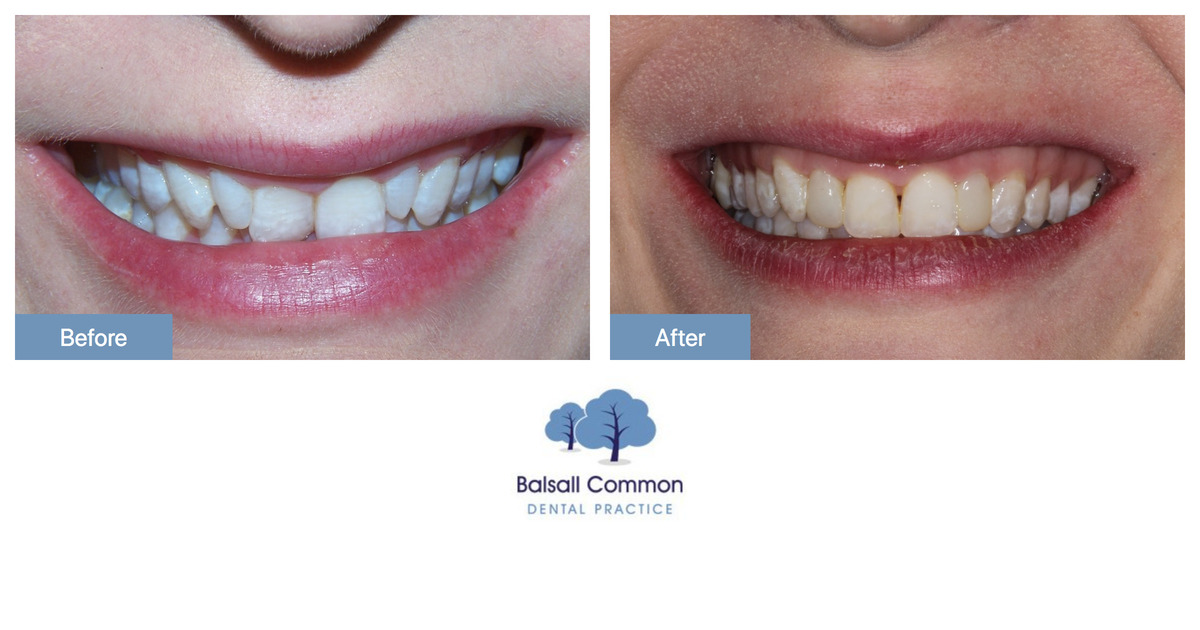 Whitening and composite bonding Balsall Common Dental