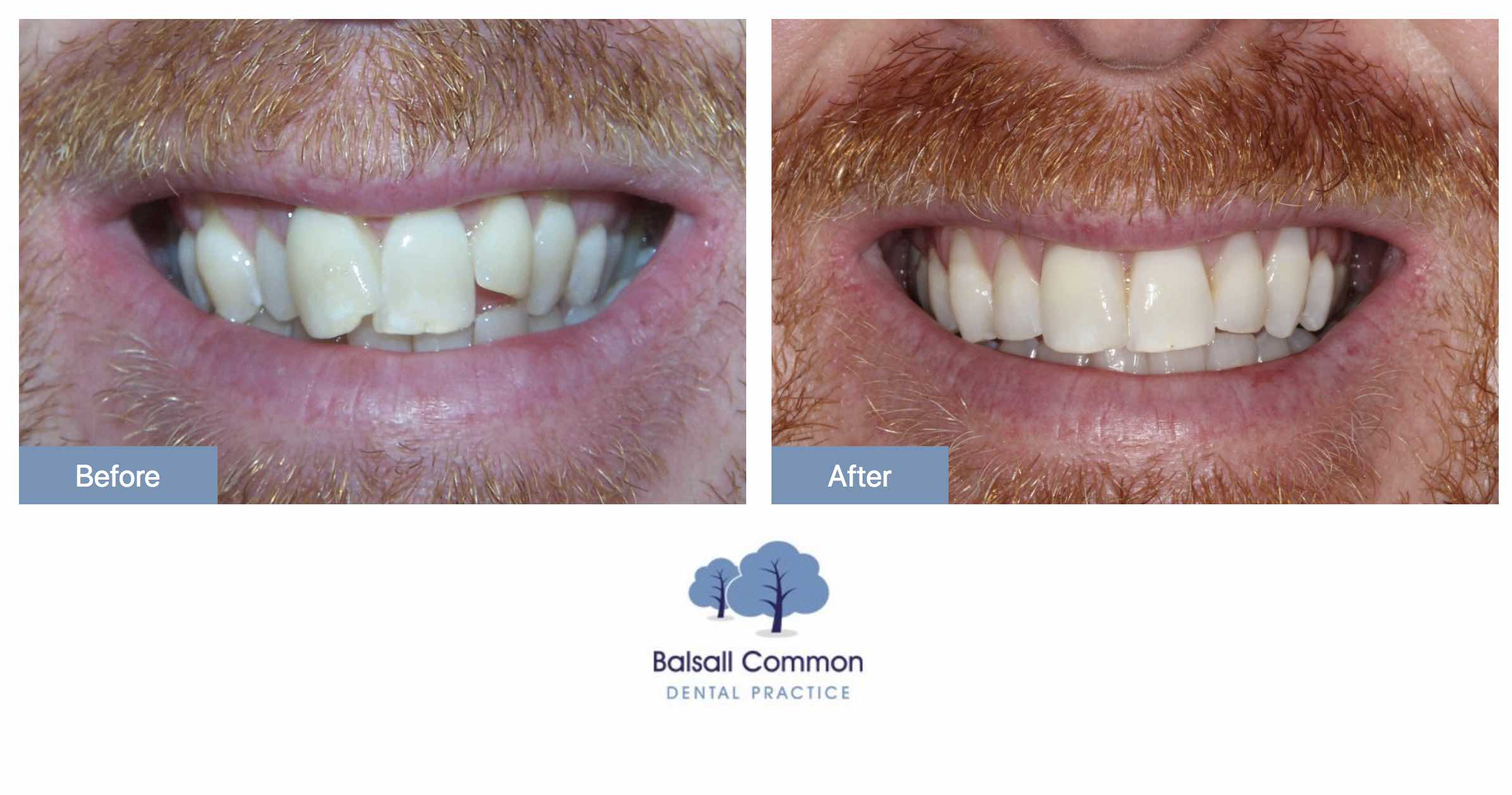 Fixed braces and bonding Balsall Common Dental