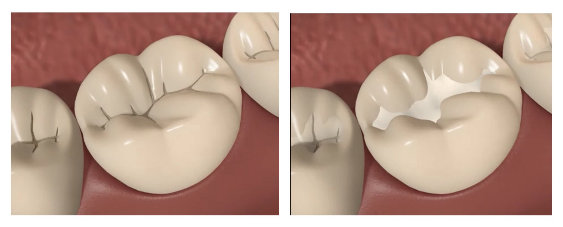 Save money on Fissure Seals