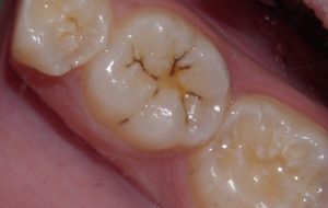 Non-sealed teeth