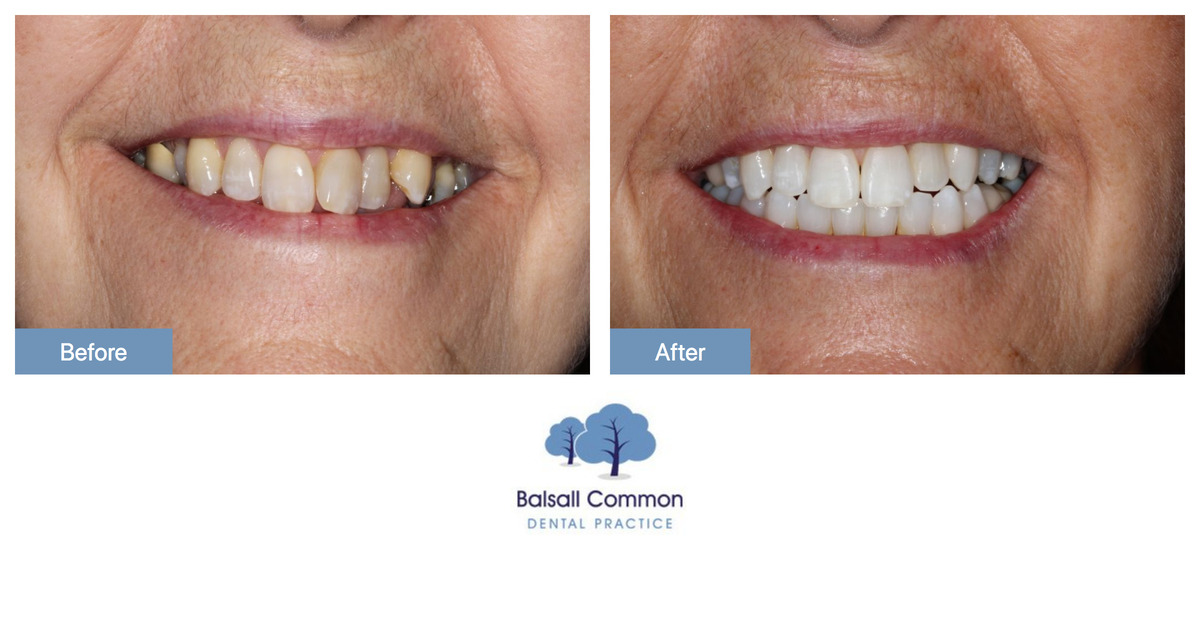 Teeth Whitening and Straightening Balsall Common Dental