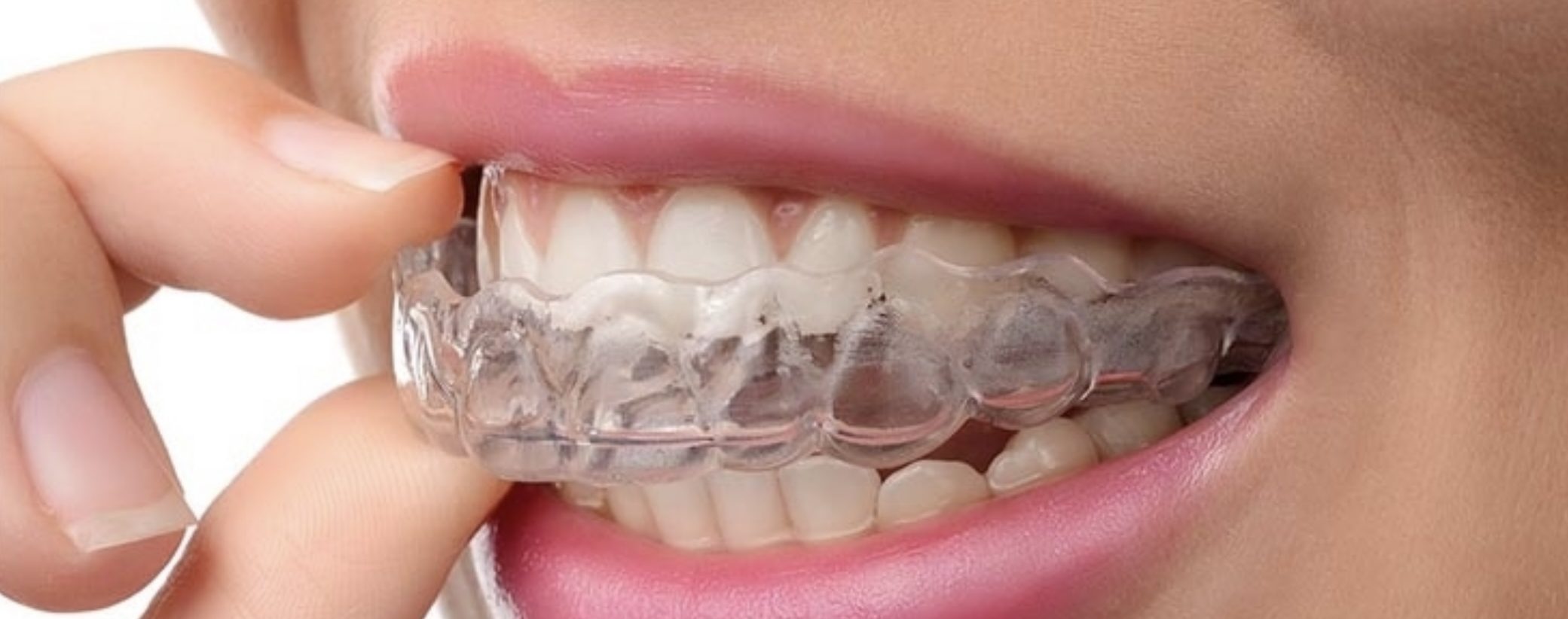 Clear Aligners